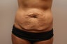 Tummy Tuck