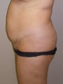 Abdominoplasty