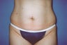 Tummy Tuck
