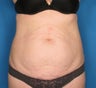 Tummy Tuck