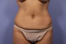 Tummy Tuck- Mommy Makeover