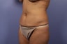 Tummy Tuck- Mommy Makeover