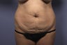 Tummy Tuck