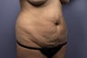 Tummy Tuck
