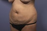 Tummy Tuck