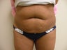 Abdominoplasty/Tummy Tuck 