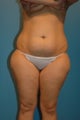 Tummy Tuck