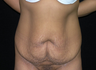 Tummy Tuck