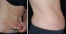 Full Tummy Tuck
