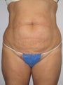 Tummy Tuck