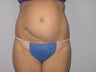 Tummy Tuck