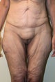 Tummy Tuck