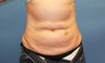 Abdominoplasty with upper hip liposuction