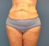 Abdominoplasty after bariatric surgery