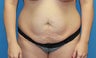 Tummy tuck with upper hip liposuction