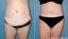 Tummy Tuck