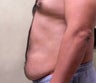Abdominoplasty (Tummy Tuck)