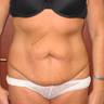 Tummy Tuck