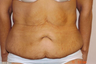 Tummy Tuck