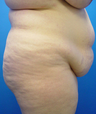Tummy Tuck