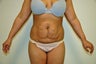 Abdominoplasty
