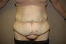 Abdominoplasty