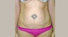 Tummy Tuck