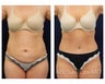 Abdominoplasty - Tummy Tuck