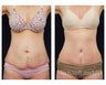 Abdominoplasty - Tummy Tuck
