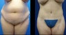 Tummy Tuck
