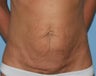 Tummy Tuck