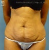 Tummy Tuck