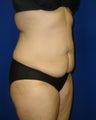 Tummy Tuck