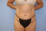 Tummy Tuck