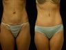 Tummy Tuck