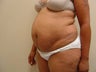 Tummy Tuck