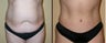 Tummy Tuck