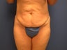 Tummy Tuck