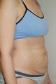 Tummy Tuck