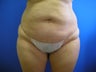 Tummy Tuck