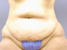 Tummy Tuck