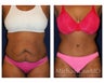 Abdominoplasty - Tummy Tuck