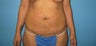 Tummy Tuck Beverly Hills