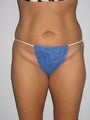 Tummy Tuck