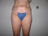 Tummy Tuck