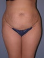 Tummy Tuck