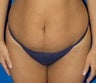 Tummy Tuck