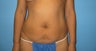 Beverly Hills tummy tuck