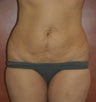 Tummy Tuck