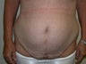 Tummy Tuck